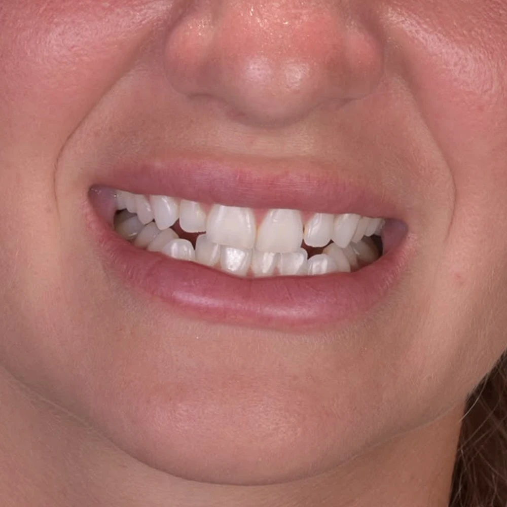 Sonrisa antes del tratamiento