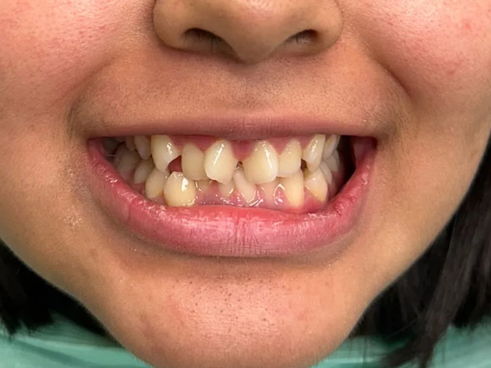 Dientes apiñados antes de la ortodoncia