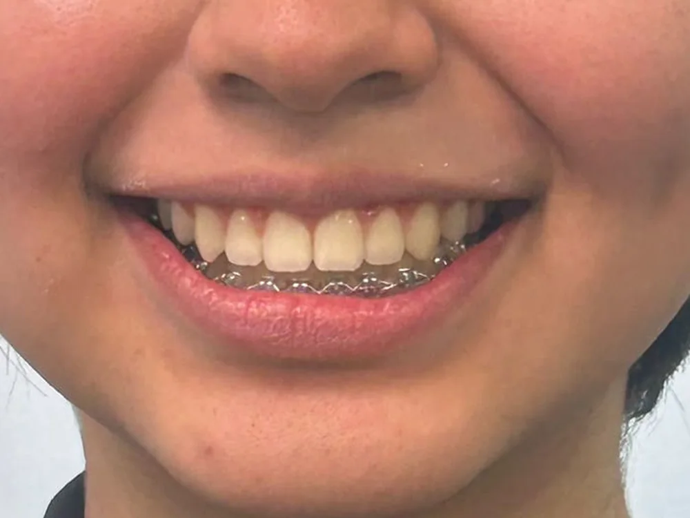 Sonrisa alineada tras la ortodoncia en BUKODENT
